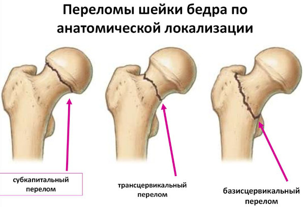 Перелом шейки бедра в пожилом возрасте. Прогноз, симптомы, лечение