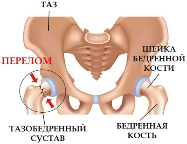 Перелом шейки бедра в пожилом возрасте. Прогноз, симптомы, лечение