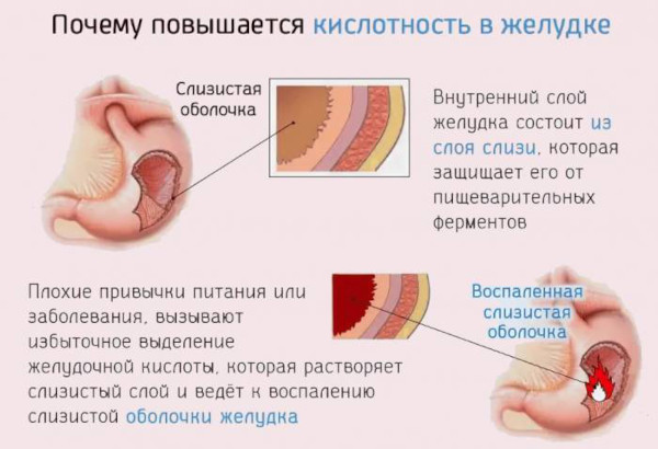 Повышенная кислотность желудка (желудочного сока). Симптомы, лечение