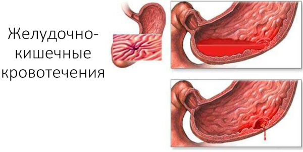 Повышенная кислотность желудка (желудочного сока). Симптомы, лечение