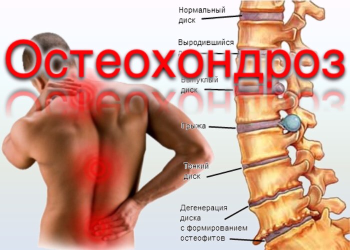 Профилактика остеохондроза шейного, поясничного, грудного отдела. Упражнения