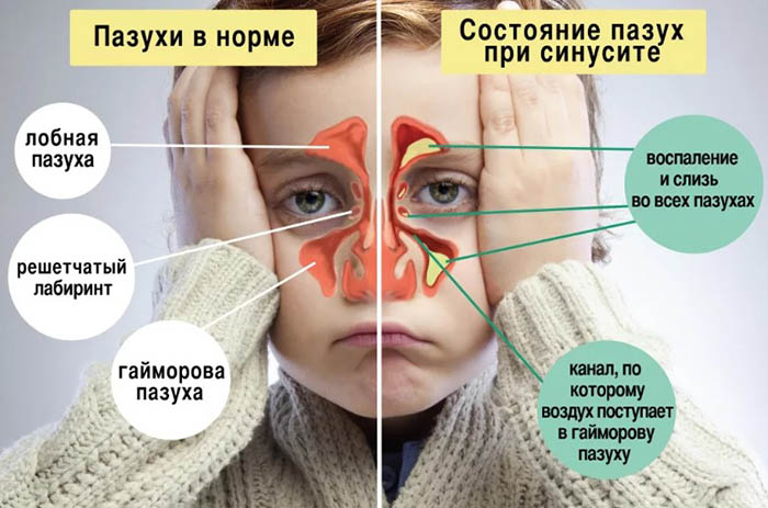 Верхнечелюстной синусит: острый, хронический. Что это такое, лечение