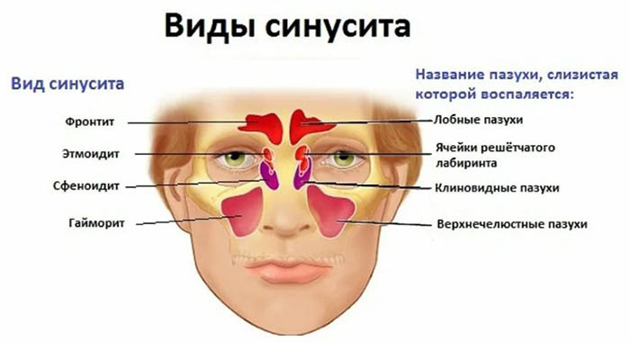 Верхнечелюстной синусит: острый, хронический. Что это такое, лечение