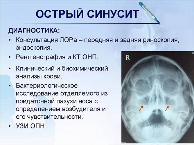 Верхнечелюстной синусит: острый, хронический. Что это такое, лечение