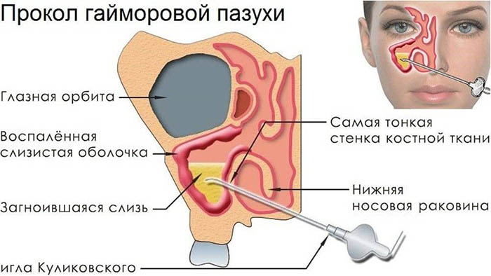 Верхнечелюстной синусит: острый, хронический. Что это такое, лечение