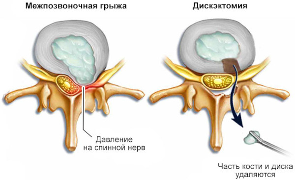 Вертеброгенная радикулопатия. Что это такое, симптомы, лечение