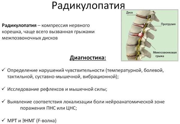 Вертеброгенная радикулопатия. Что это такое, симптомы, лечение