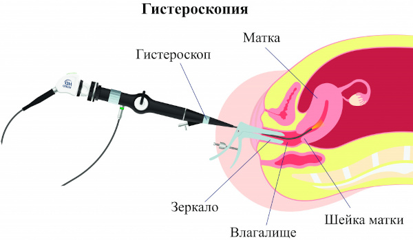 Выделения после гистероскопии матки с выскабливанием. Как долго могут длиться