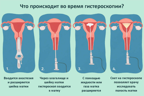 Выделения после гистероскопии матки с выскабливанием. Как долго могут длиться