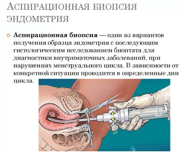 Аспирационная биопсия эндометрия (АБЭ). Что это такое