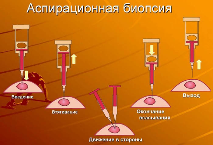 Аспирационная биопсия эндометрия (АБЭ). Что это такое