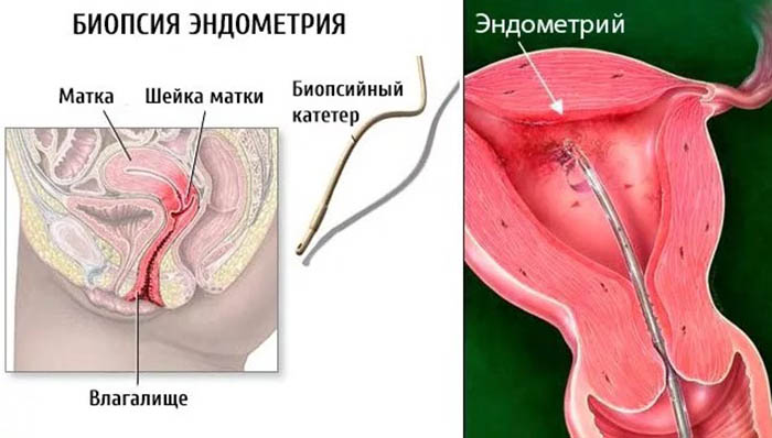 Аспирационная биопсия эндометрия (АБЭ). Что это такое