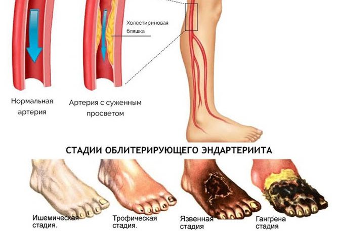 Болезнь Бюргера. Симптомы и лечение, клинические рекомендации