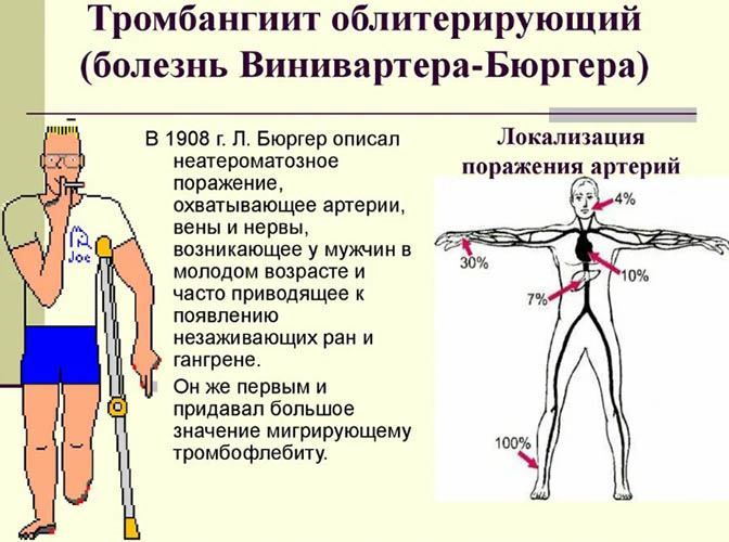 Болезнь Бюргера. Симптомы и лечение, клинические рекомендации