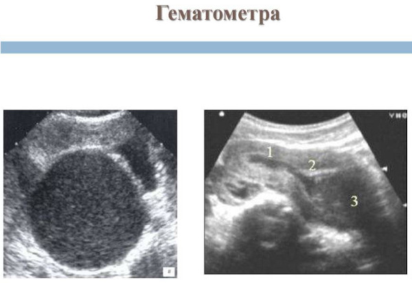 Гематометра. Что это такое у женщин, лечение