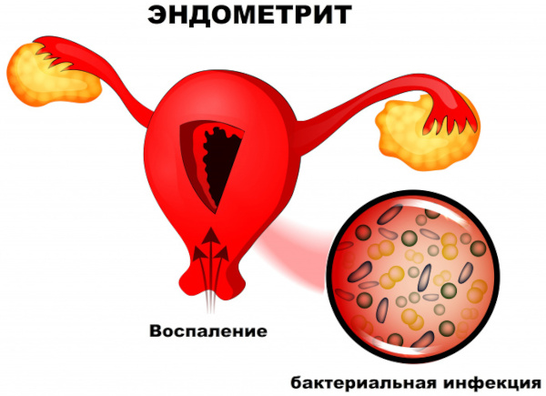 Гематометра. Что это такое у женщин, лечение