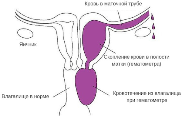 Гематометра. Что это такое у женщин, лечение