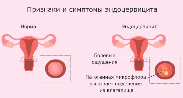 Гематометра. Что это такое у женщин, лечение