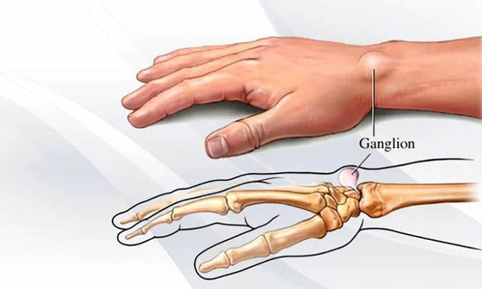 Гигрома запястья руки. Причины возникновения, лечение