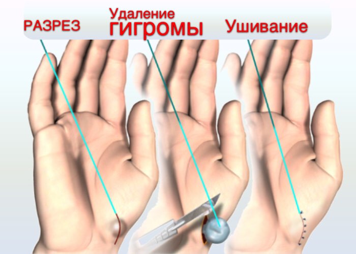 Гигрома запястья руки. Причины возникновения, лечение