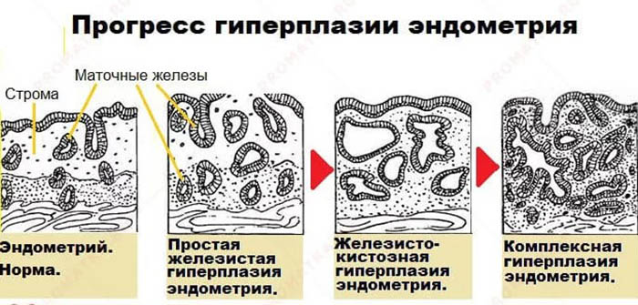 Гиперплазия яичников у женщин. Что это, что значит, лечение