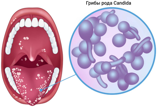Грибковая инфекция в горле. Симптомы, лечение