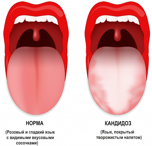 Грибковая инфекция в горле. Симптомы, лечение