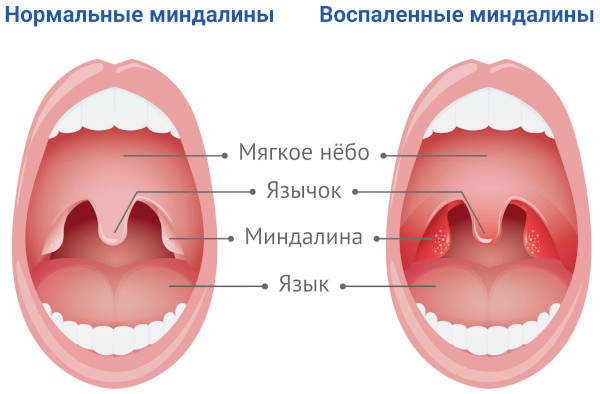 Грибковая инфекция в горле. Симптомы, лечение