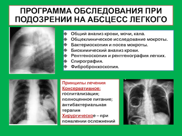 Хронический абсцесс легкого. Клинические рекомендации, лечение