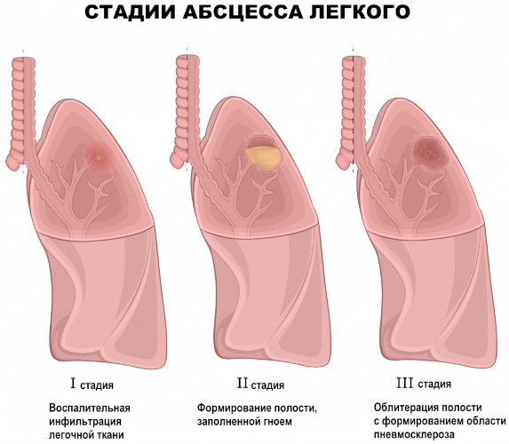 Хронический абсцесс легкого. Клинические рекомендации, лечение