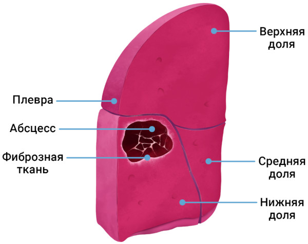 Хронический абсцесс легкого. Клинические рекомендации, лечение