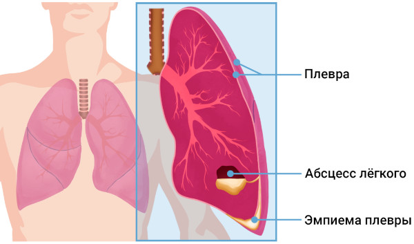 Хронический абсцесс легкого. Клинические рекомендации, лечение
