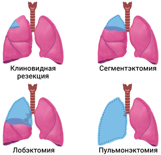 Хронический абсцесс легкого. Клинические рекомендации, лечение