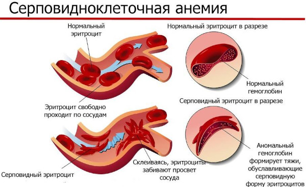 Ишемическая болезнь головного мозга. Что это у пожилых