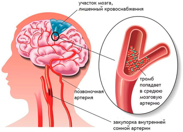 Ишемическая болезнь головного мозга. Что это у пожилых