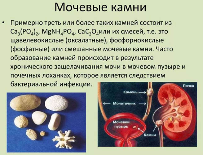 Камни в почках. Причины образования, от чего появляются