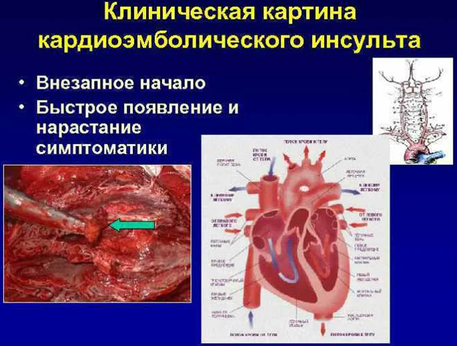 Кардиоэмболический инсульт. Что это, причины, лечение