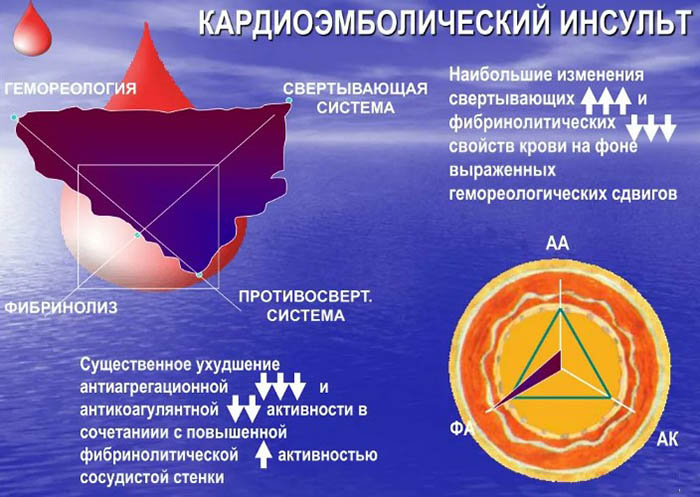 Кардиоэмболический инсульт. Что это, причины, лечение