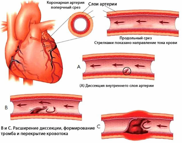 Кардиоэмболический инсульт. Что это, причины, лечение