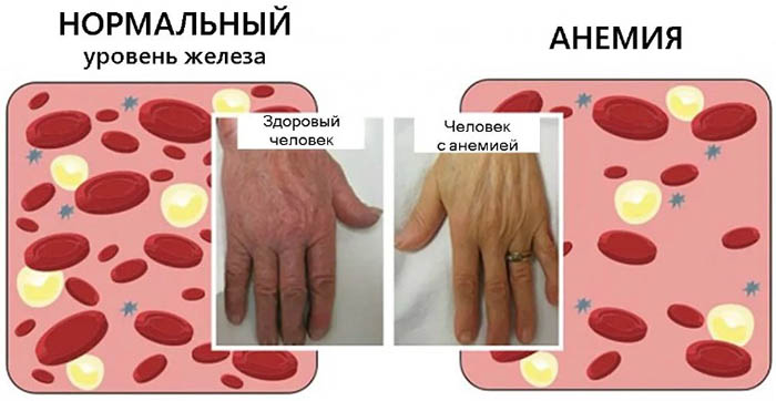 Опасность анемии для женщин после 40-45-50 лет