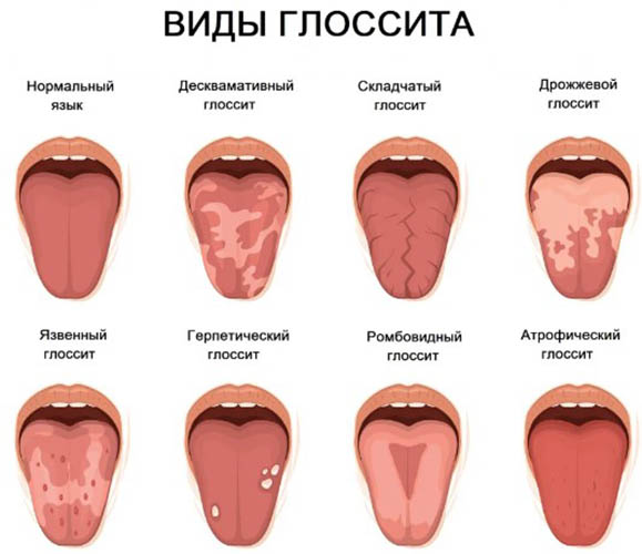 Почему трескается язык у человека. Причины, как лечить