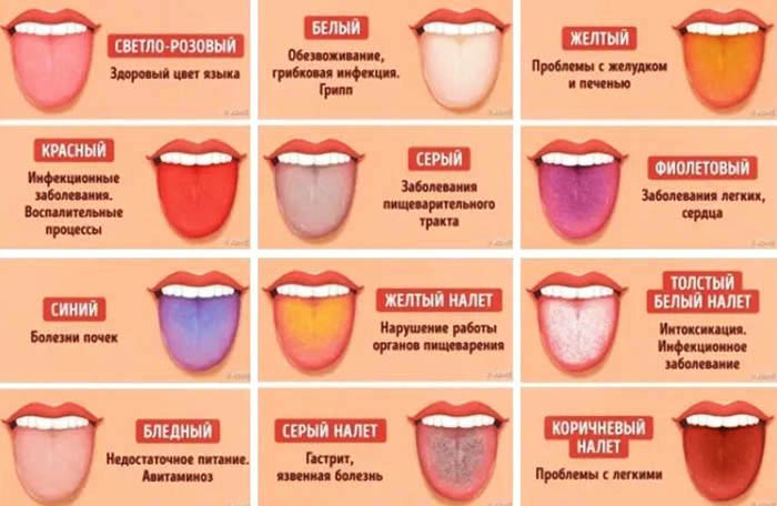 Почему трескается язык у человека. Причины, как лечить