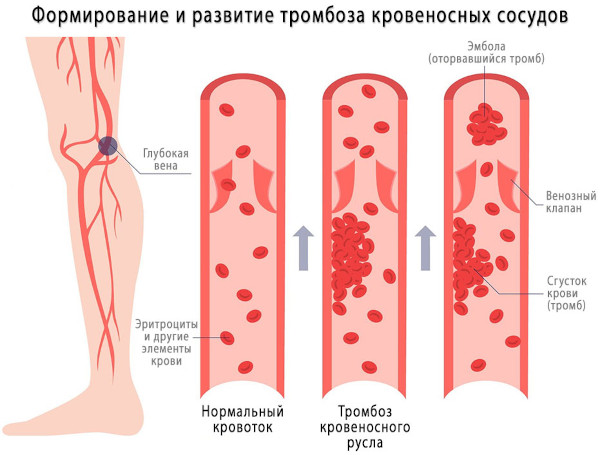 Полицитемия вторичная (ложная). Прогноз, что это за болезнь