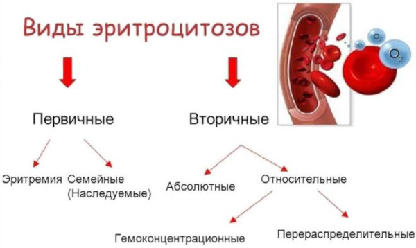 Полицитемия вторичная (ложная). Прогноз, что это за болезнь