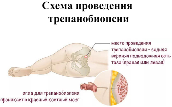 Полицитемия вторичная (ложная). Прогноз, что это за болезнь