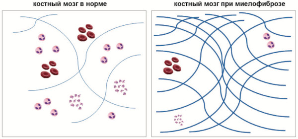 Полицитемия вторичная (ложная). Прогноз, что это за болезнь