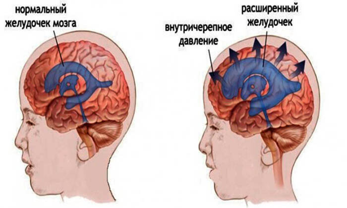 Признаки внутричерепной гипертензии, косвенные симптомы