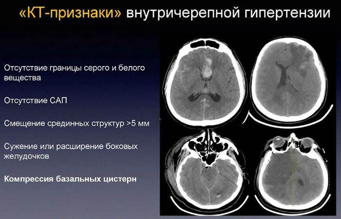 Признаки внутричерепной гипертензии, косвенные симптомы