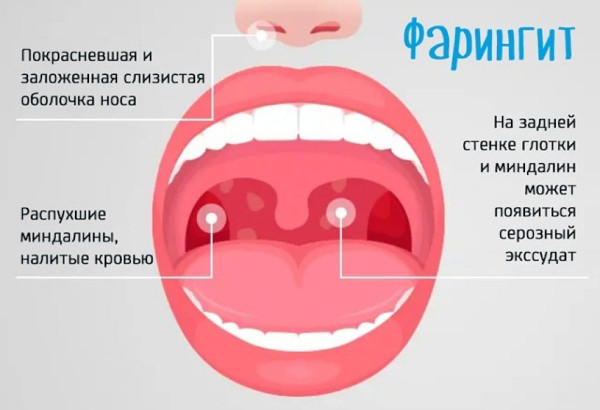 Субатрофический фарингит фото