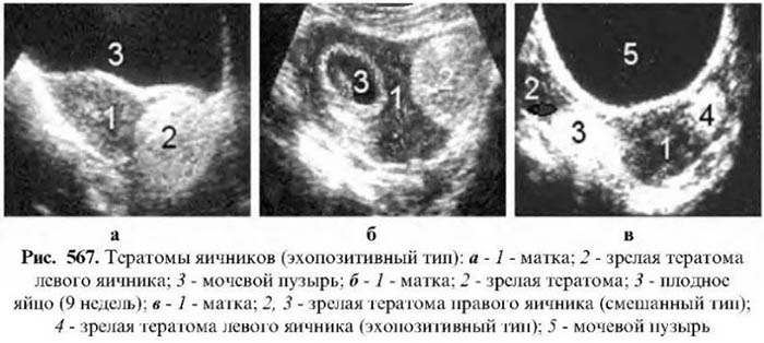 Тератома яичника. Что это такое у женщин, клинические рекомендации